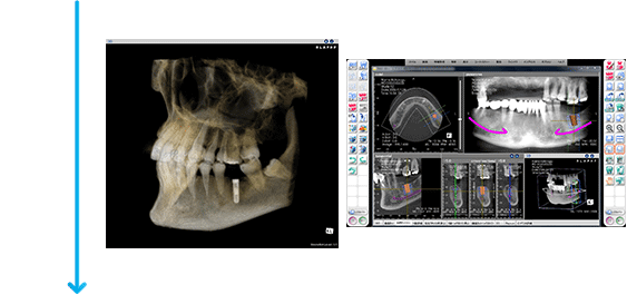 骨上ガイドプレートの作成