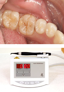 レーザーで虫歯を確認します。