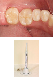 上の写真のように虫歯を拡大して見てもらえます。