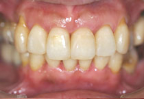 隙間を埋めた後