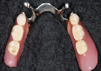 部分入れ歯